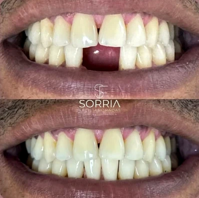 Resultado odontológico antes e depois