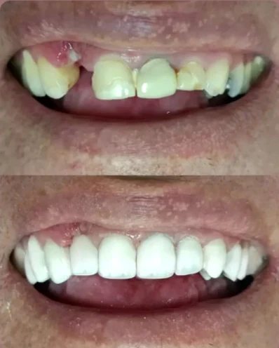 Resultado de sorriso antes e depois