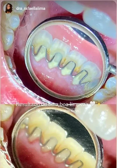 Resultado de limpeza odontológica